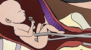 डोटीमा गर्भपतन गराउने महिलाको सङ्ख्या बढ्दै